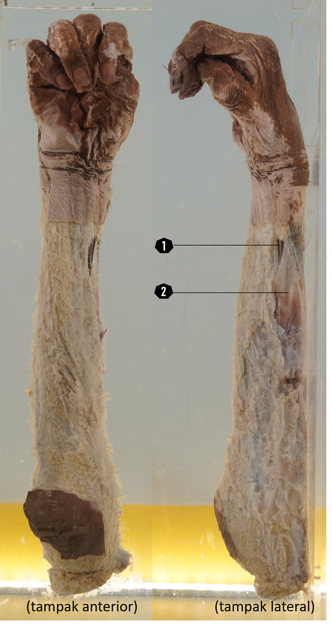 Lengan bawah + tangan kanan (struktur permukaan, tampak anterolateral)