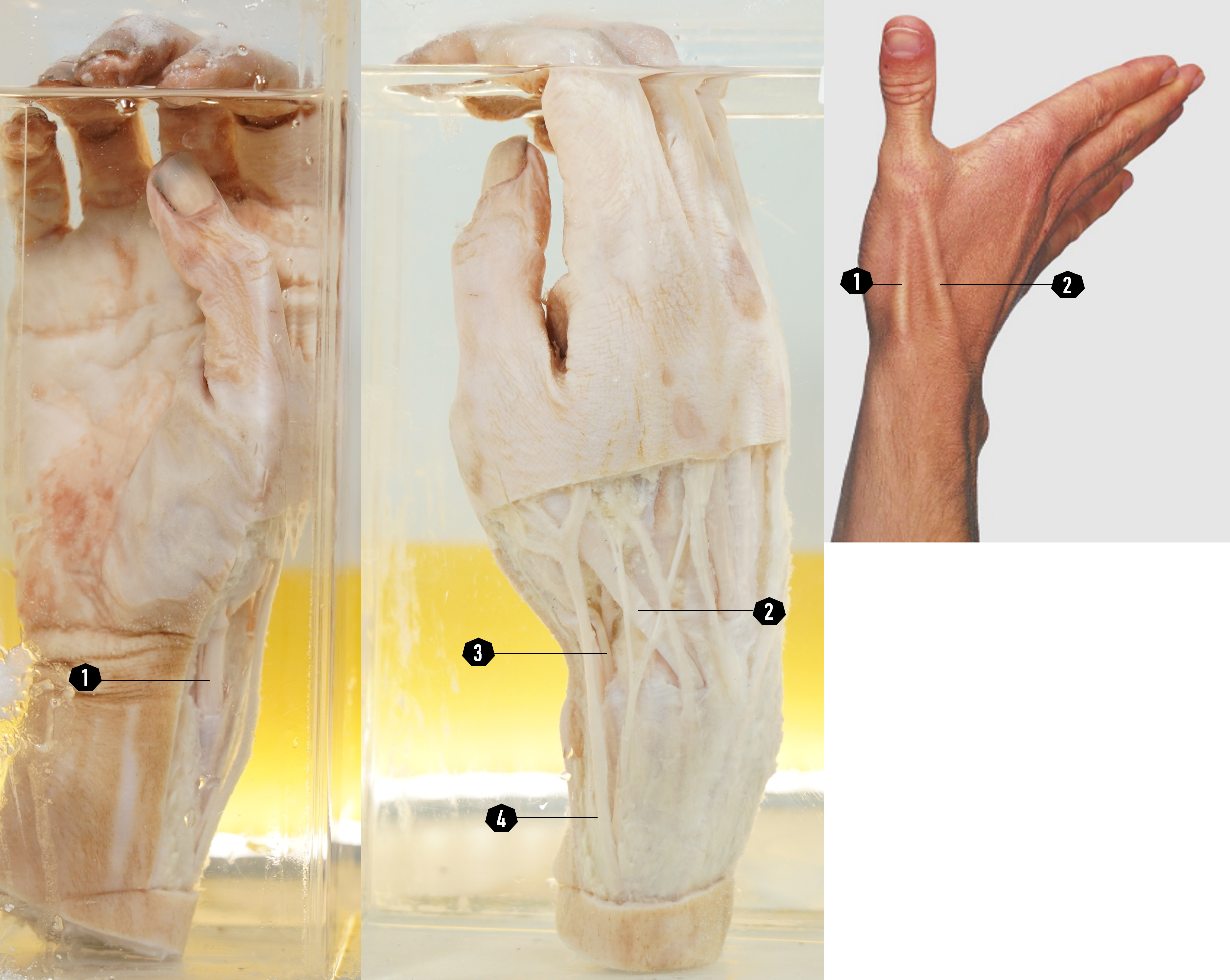 Telapak tangan kanan (struktur permukaan, tampak anterior dan posterolateral)