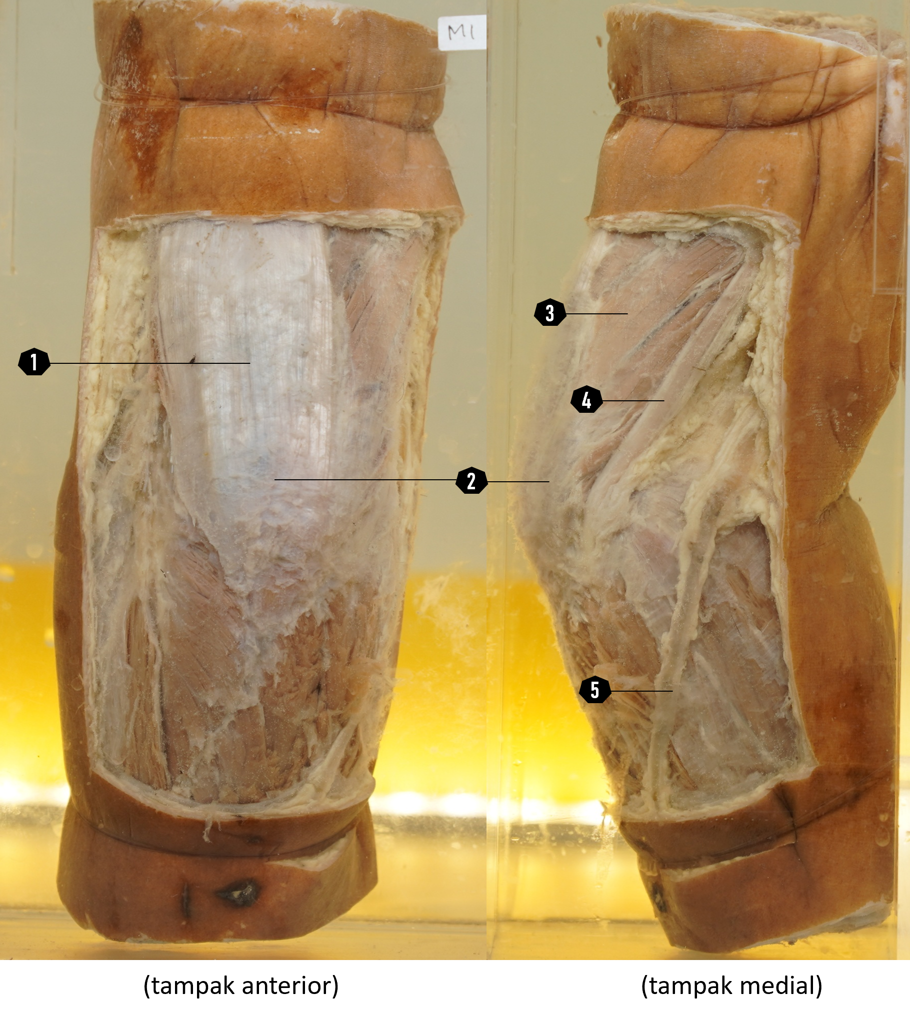 Sendi lutut kiri (struktur permukaan, tampak anterior dan lateral)